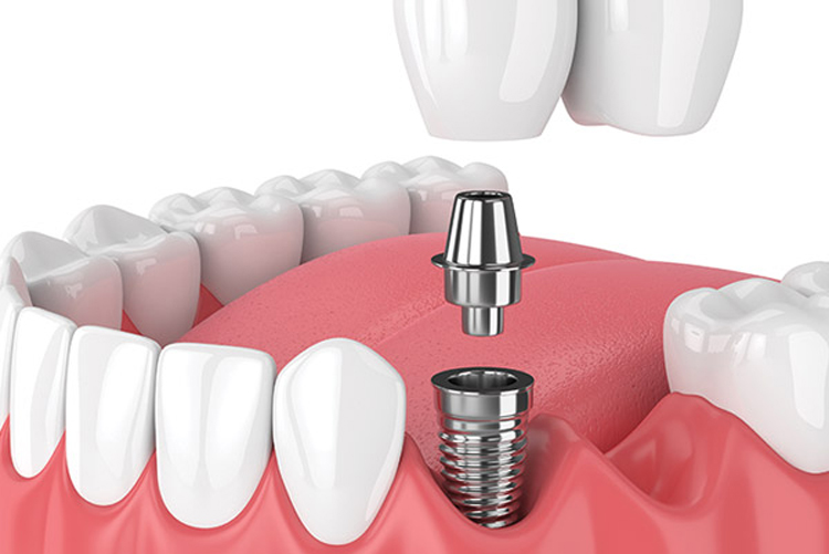 IMPLANT-SUPPORTED CROWNS/BRIDGES