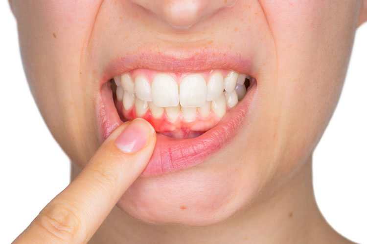 GUMS & SUPPORTIVE TISSUE TREATMENTS